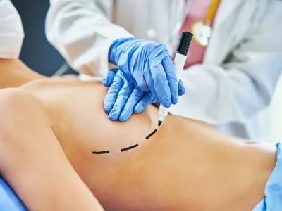 Warum sich immer mehr Frauen für eine Brustvergrößerung mit Eigenfett entscheiden